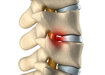 herniated-disc