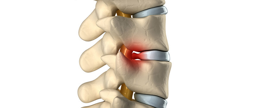 herniated-disc
